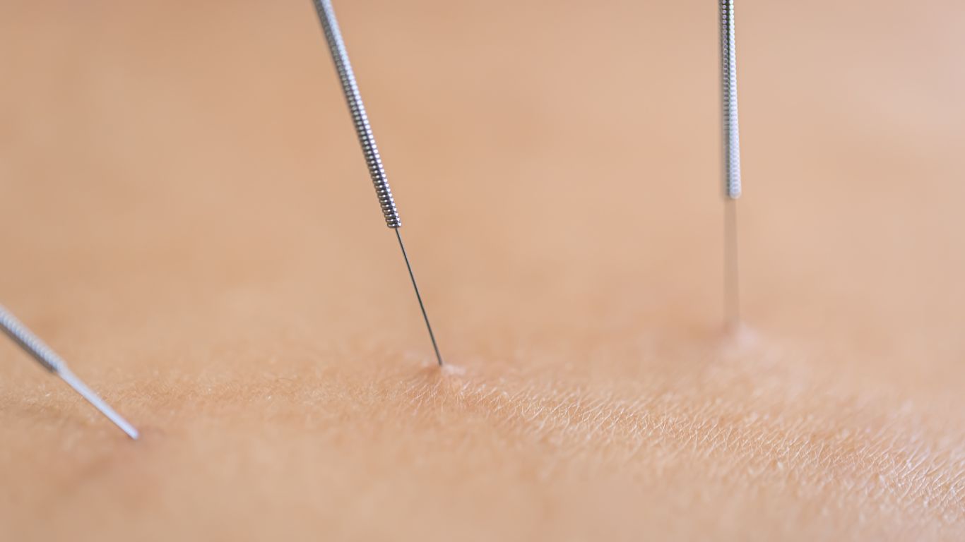 A Ciência por trás das agulhas